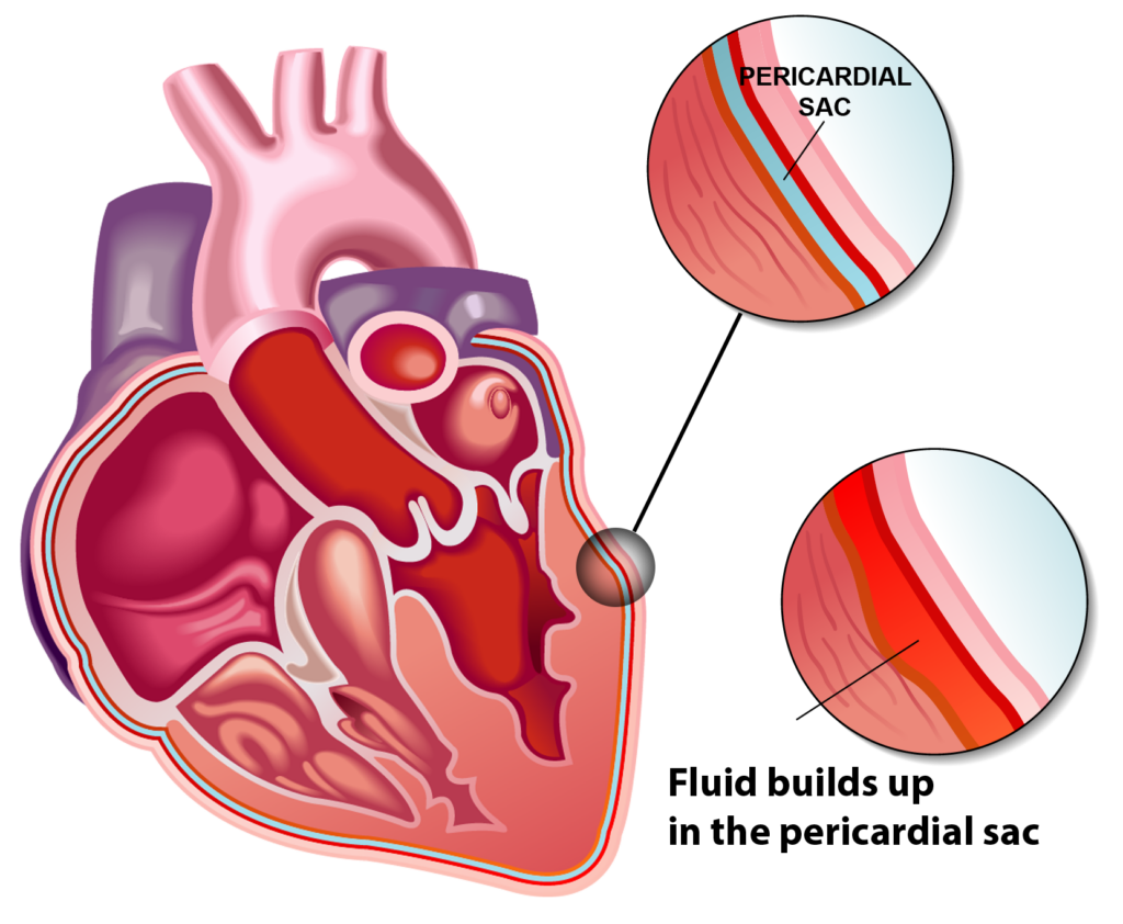 The heart is enclosed inside a pericardium or pericardial sac. On the right side is a close-up of a normal pericardium. The lower image is a close-up of an inflamed pericardial sac.