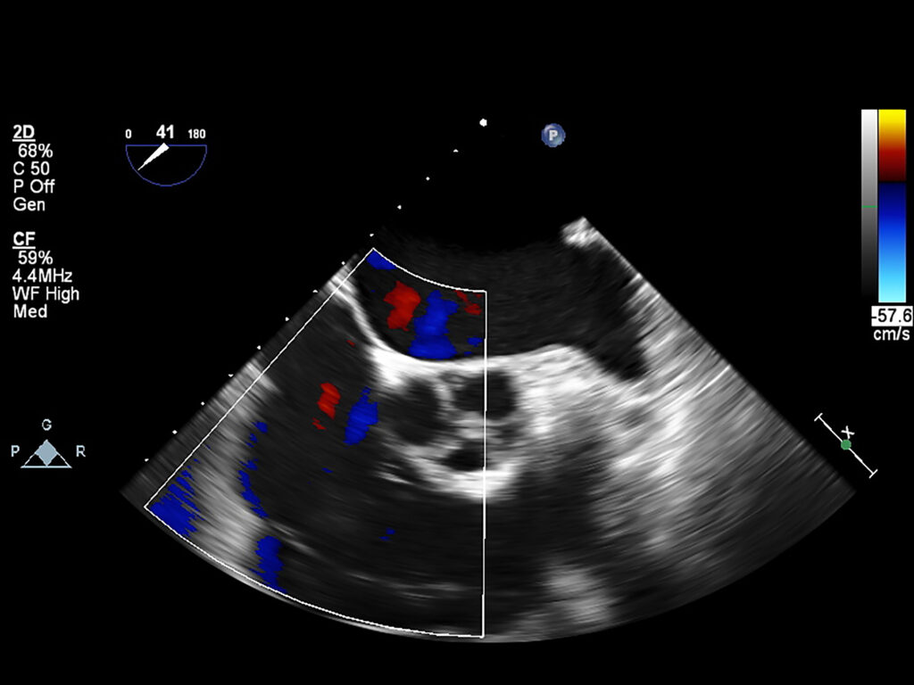 An echocardiogram is an ultrasound scan of the heart and nearby blood vessels.