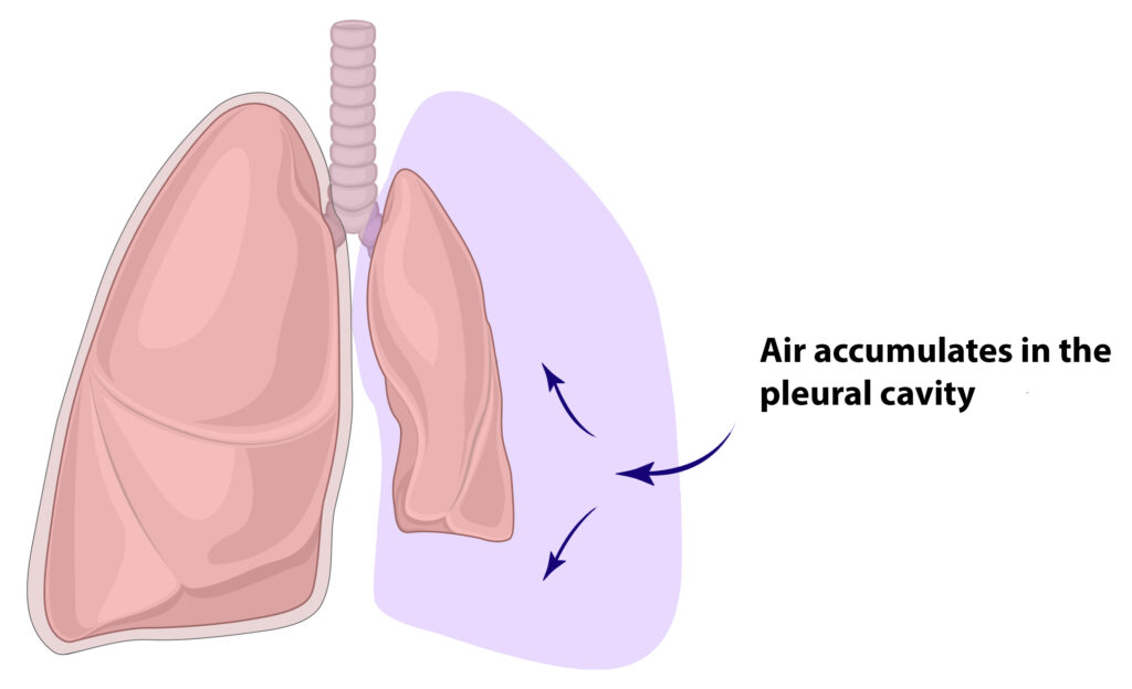 With tension pneumothorax, there's some kind of damage to the lungs, and maybe even to the pleural sac such that air escapes and gets into that pleural space. And the more you breathe in, the more air fills in that space putting more pressure on the lungs and hence, making it hard for the lungs to expand to take in the air well.