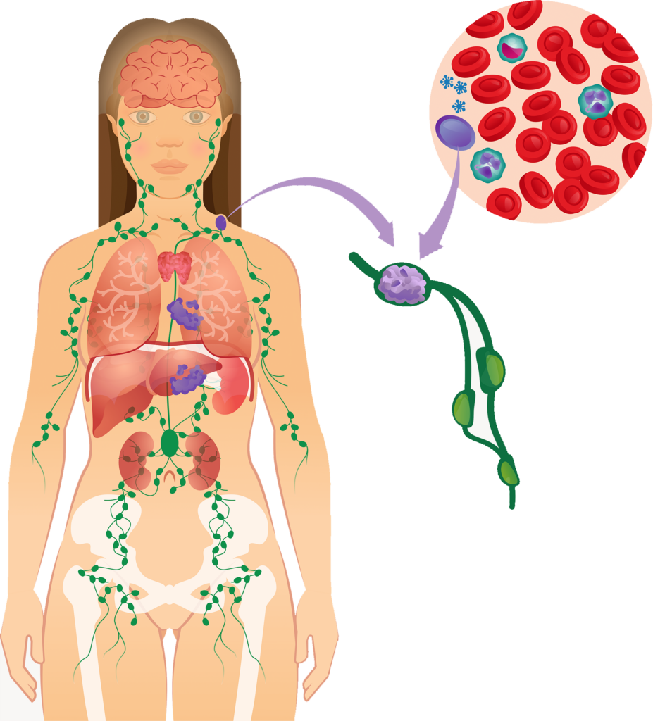 Lymphoma is cancer affecting lymphatic tissues. There is a proliferation of the B and T cells that can collect in the lymph nodes, spleen, liver, and also in other tissues.  