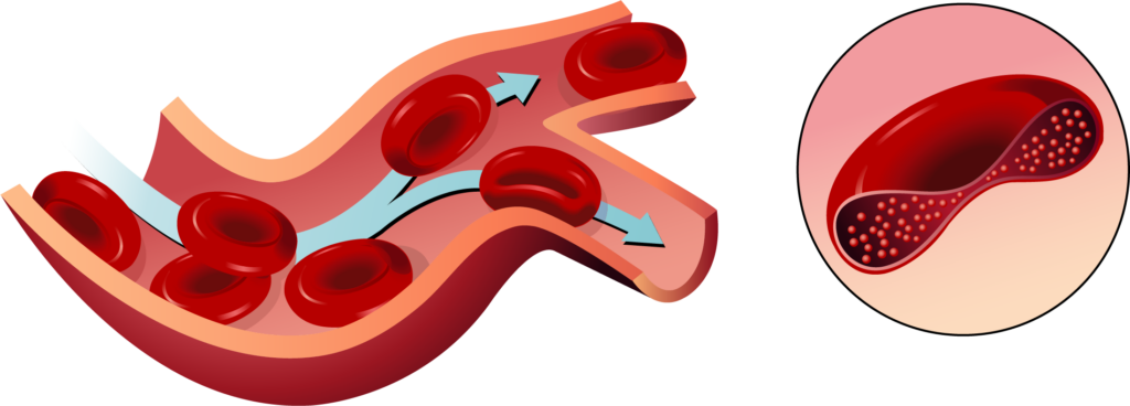 Membranes of normal red blood cells are flexible  allowing them to squeeze through really tight spots.