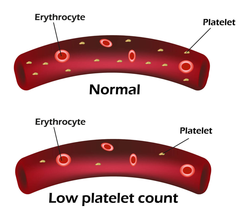 A person with thrombocytopenia has a low platelet count in the blood. This means that he/she is less likely to form clots and is at risk of excessive bleeding when there’s some kind of damage or injury. 