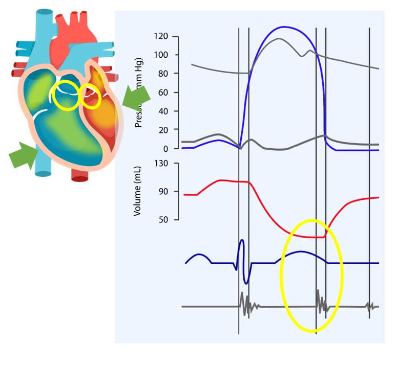The second heart sound, the "Dub" sound, happens after the T wave when the ventricles are relaxing and the semilunar valves close.